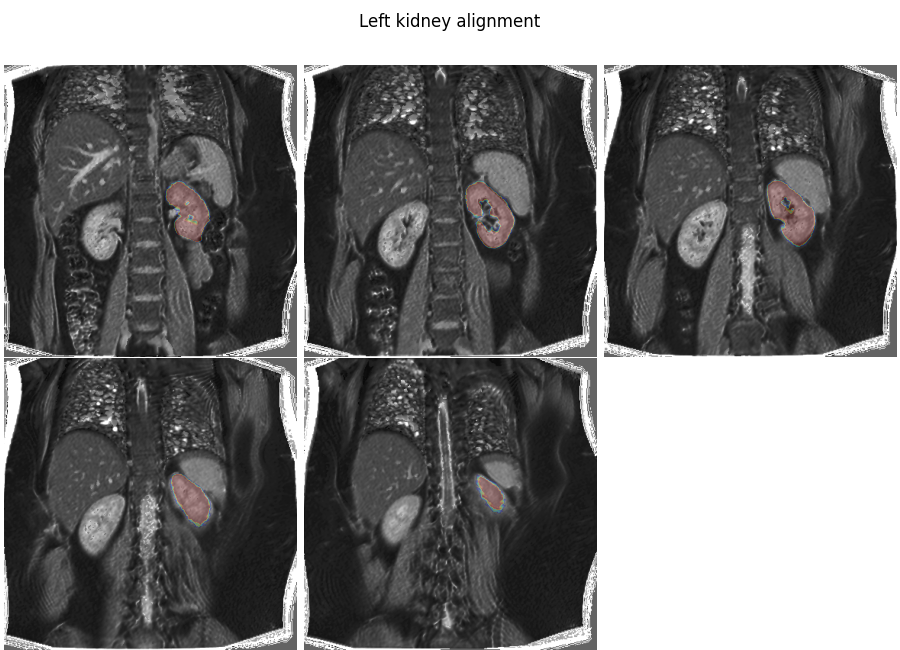 Left kidney alignment