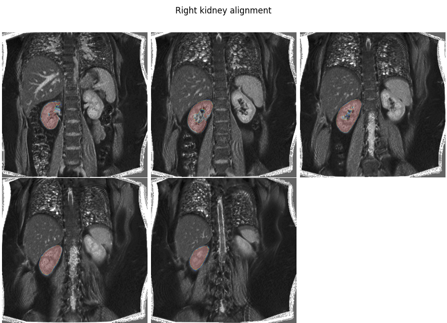 Right kidney alignment