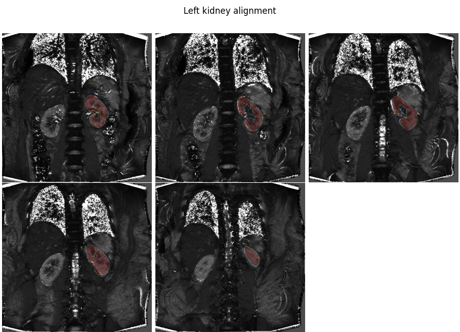 Left kidney alignment