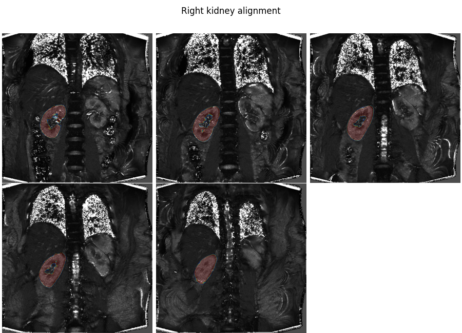 Right kidney alignment